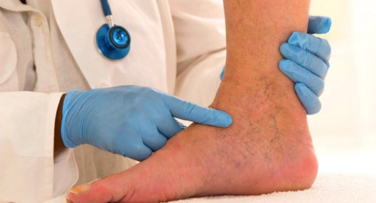 درمان واریس اصفهان | دکتر مهرداد طاهریون