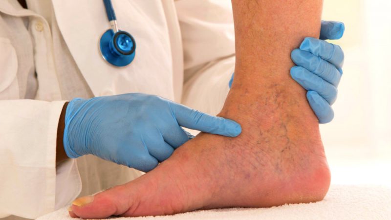 درمان واریس اصفهان | دکتر مهرداد طاهریون