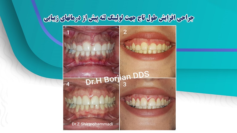 پیوند لثه و استخوان | دکتر حسین برجیان