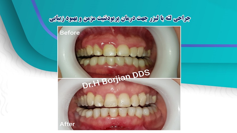 جراحی لثه با لیزر | دکتر حسین برجیان