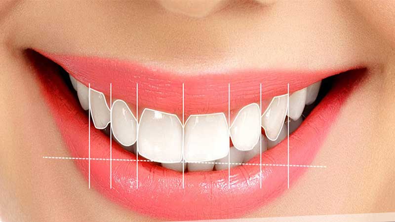 طرح لبخند اصفهان با دکتر حسین برجیان | لیزر دندانپزشکی اصفهان