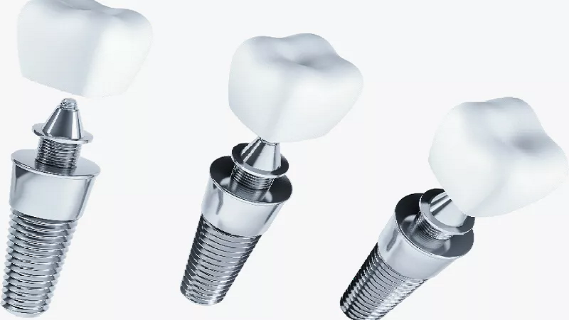 قیمت ایمپلنت دندان در اصفهان | دکتر حسین برجیان