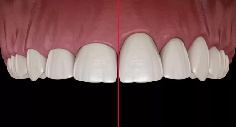 بهترین جراح لیفت لثه اصفهان